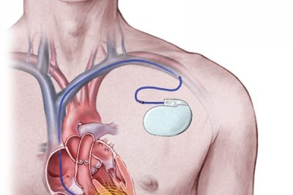 0001_defibriliatorius_1564985556-04d782584280bf0f4abb89c60c1be488.jpg