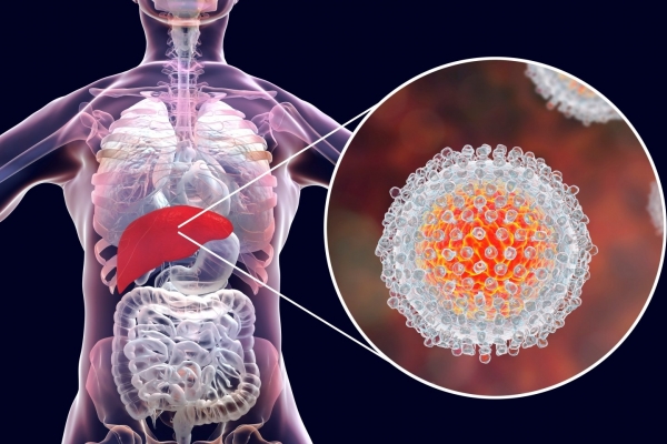 0001_hepatitas_1658997985-17255cee6bb621dc4ddc07860dd0d0a8.jpg